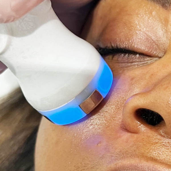 Radiofrequency Facial Skin Tightening 