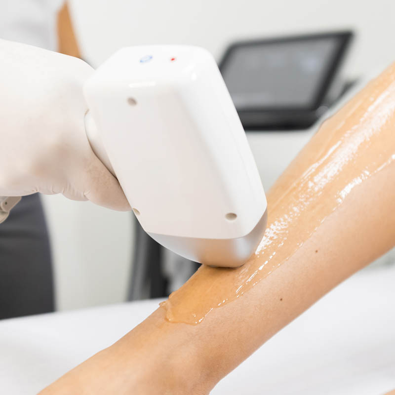 Laser Hair Removal
